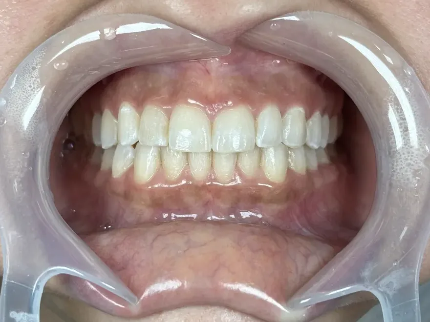 Sorriso depois do clareamento